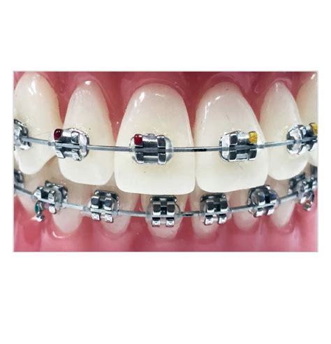 bracket metal mini orthodontic|stainless steel orthodontic braces.